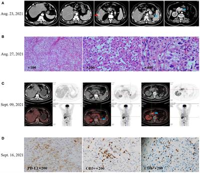 Case report: Abolishing primary resistance to PD-1 blockade by short-term treatment of lenvatinib in a patient with advanced metastatic renal cell carcinoma